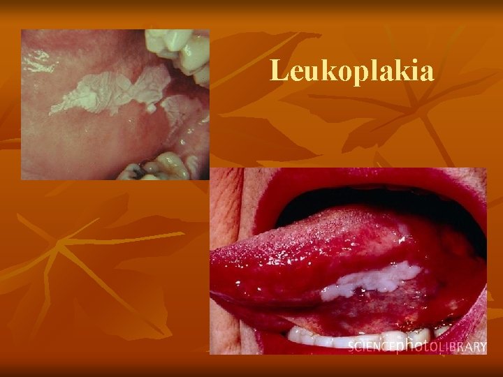 Leukoplakia 