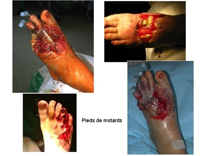 Pieds de motards 