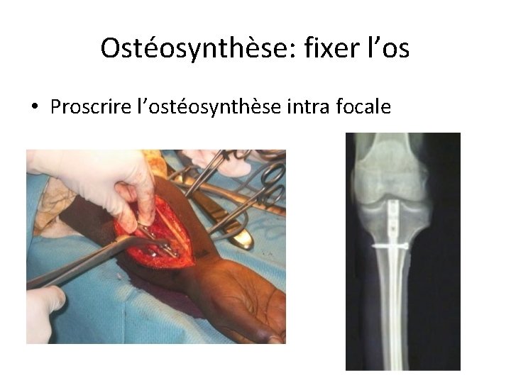 Ostéosynthèse: fixer l’os • Proscrire l’ostéosynthèse intra focale 