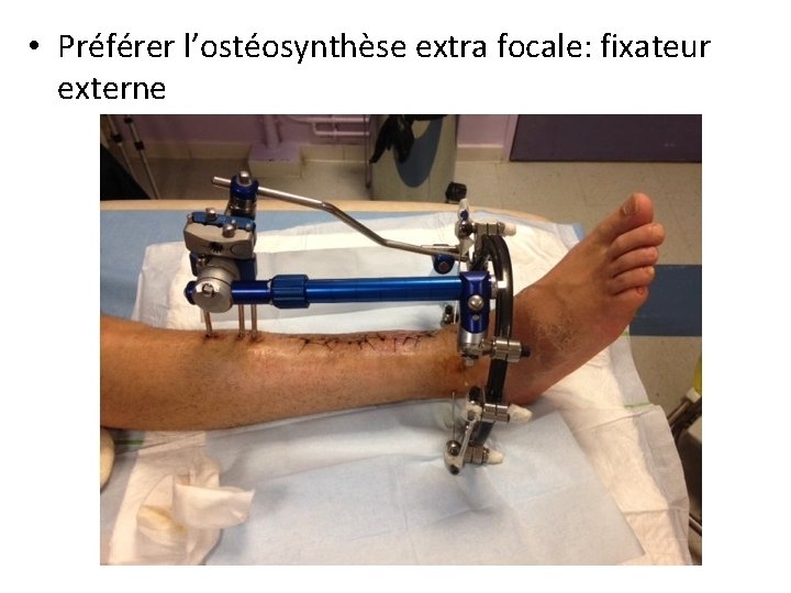  • Préférer l’ostéosynthèse extra focale: fixateur externe 