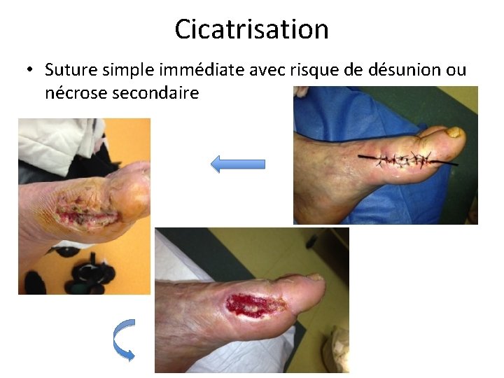 Cicatrisation • Suture simple immédiate avec risque de désunion ou nécrose secondaire 