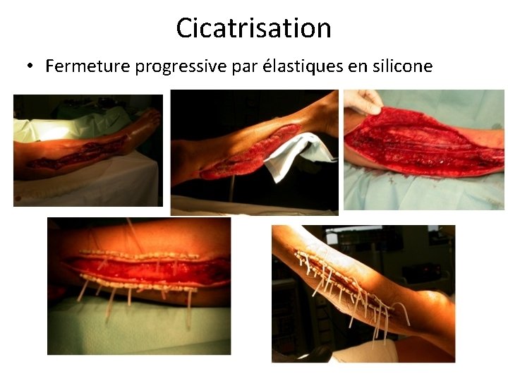 Cicatrisation • Fermeture progressive par élastiques en silicone 