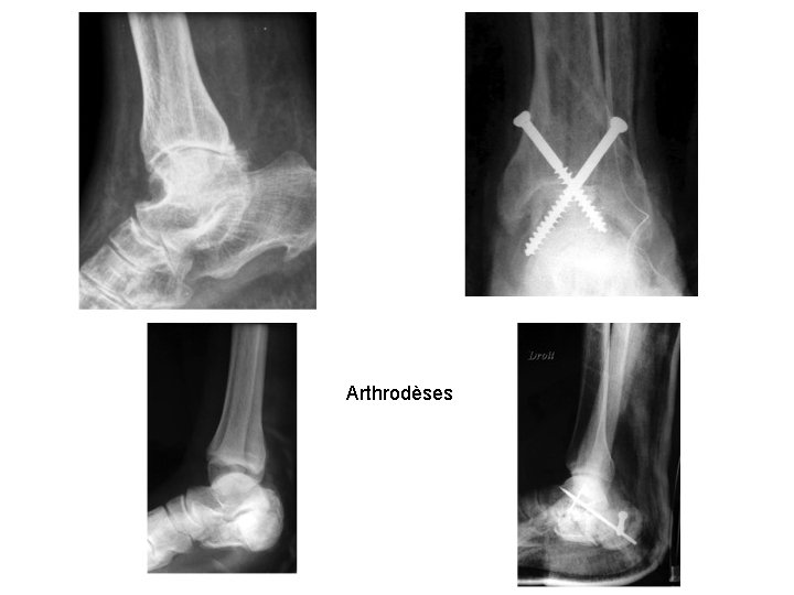 Arthrodèses 