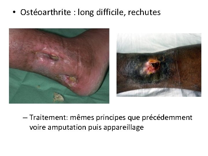  • Ostéoarthrite : long difficile, rechutes – Traitement: mêmes principes que précédemment voire