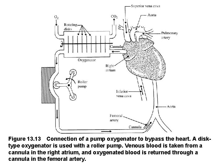 Figure 13. 13 Connection of a pump oxygenator to bypass the heart. A disk