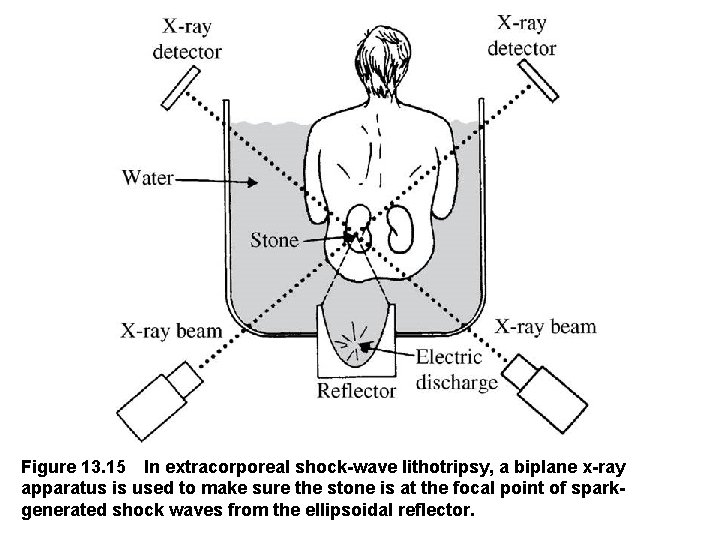 Figure 13. 15 In extracorporeal shock wave lithotripsy, a biplane x ray apparatus is