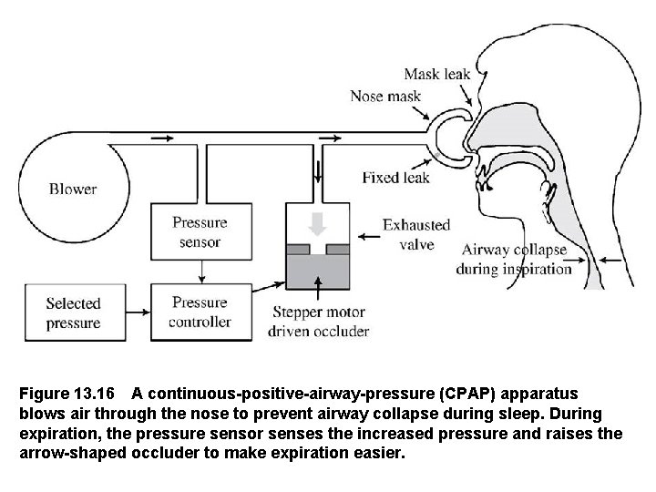 Figure 13. 16 A continuous positive airway pressure (CPAP) apparatus blows air through the
