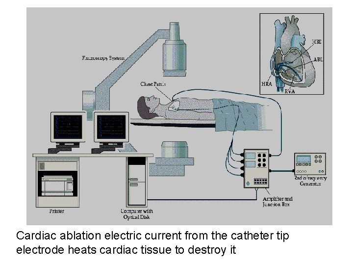 Cardiac ablation electric current from the catheter tip electrode heats cardiac tissue to destroy