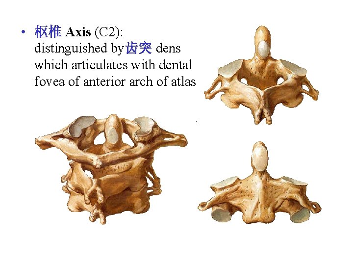 • 枢椎 Axis (C 2): distinguished by齿突 dens which articulates with dental fovea • 枢椎 Axis (C 2): distinguished by齿突 dens which articulates with dental fovea