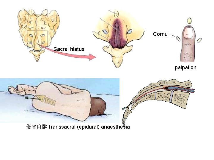 Cornu Sacral hiatus palpation 骶管麻醉Transsacral (epidural) anaesthesia Cornu Sacral hiatus palpation 骶管麻醉Transsacral (epidural) anaesthesia