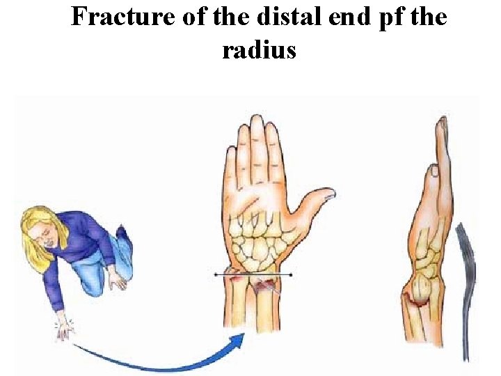 Fracture of the distal end pf the radius Fracture of the distal end pf the radius