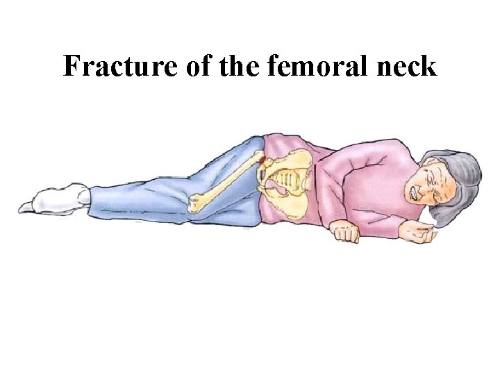 Fracture of the femoral neck Fracture of the femoral neck