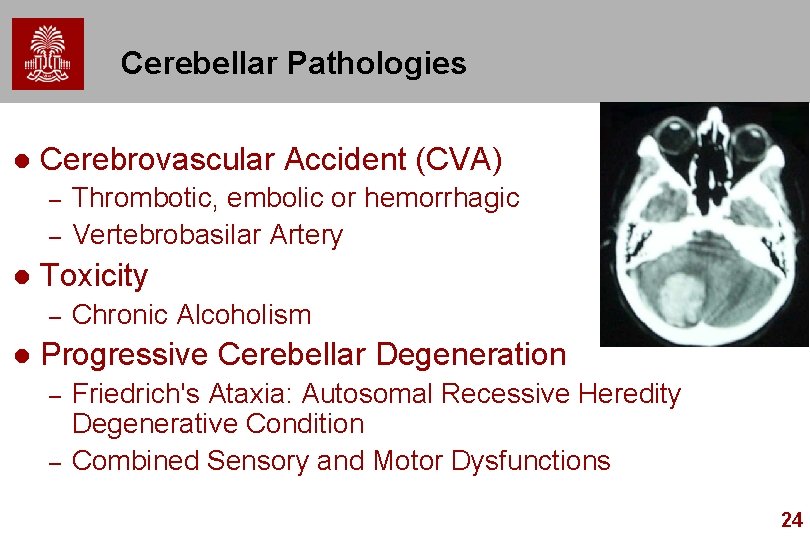 Cerebellar Pathologies l Cerebrovascular Accident (CVA) – – l Toxicity – l Thrombotic, embolic