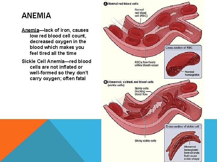 ANEMIA Anemia—lack of iron, causes low red blood cell count, decreased oxygen in the