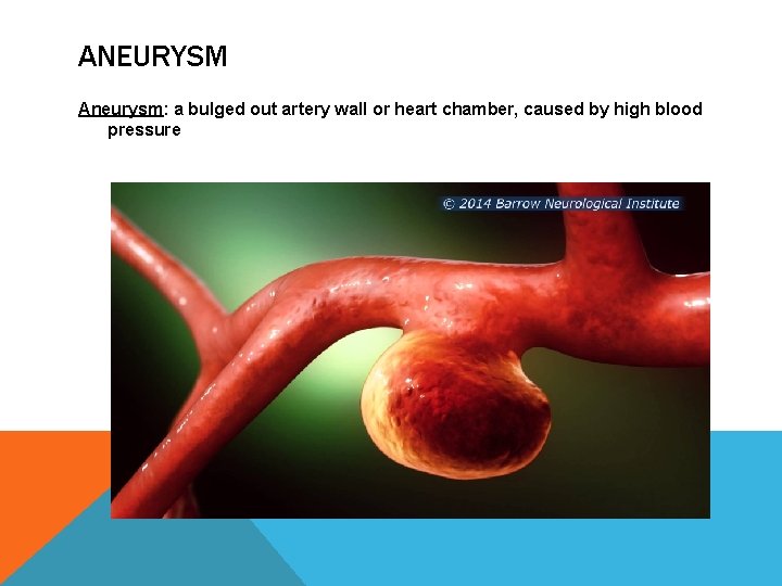 ANEURYSM Aneurysm: a bulged out artery wall or heart chamber, caused by high blood