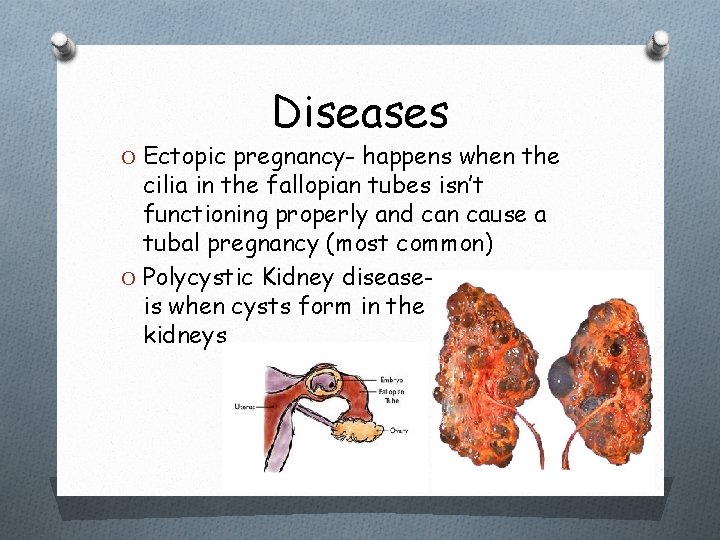 Diseases O Ectopic pregnancy- happens when the cilia in the fallopian tubes isn’t functioning
