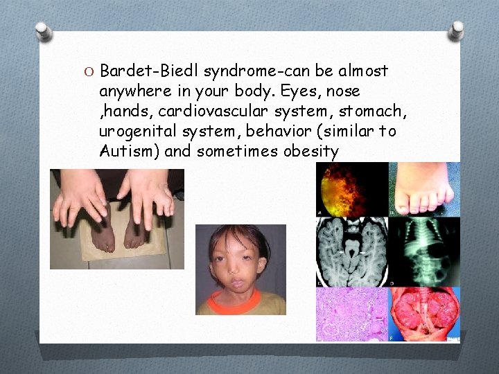 O Bardet-Biedl syndrome-can be almost anywhere in your body. Eyes, nose , hands, cardiovascular