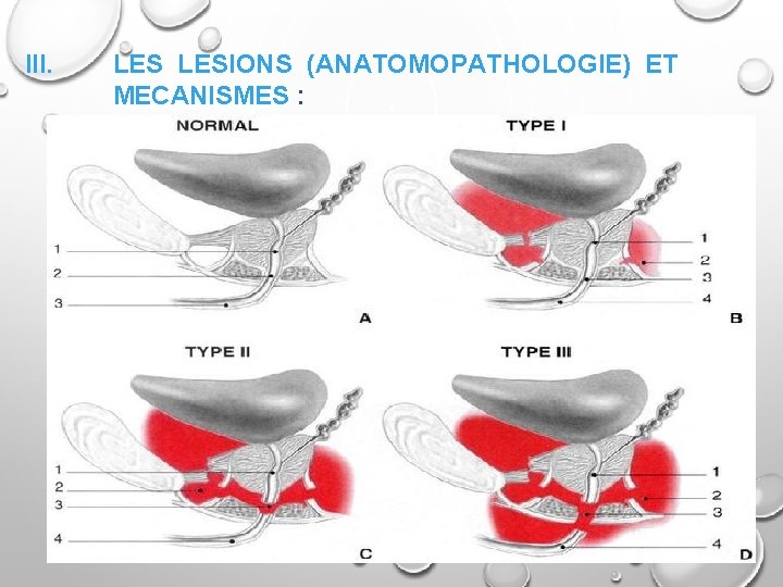 III. LESIONS (ANATOMOPATHOLOGIE) ET MECANISMES : 