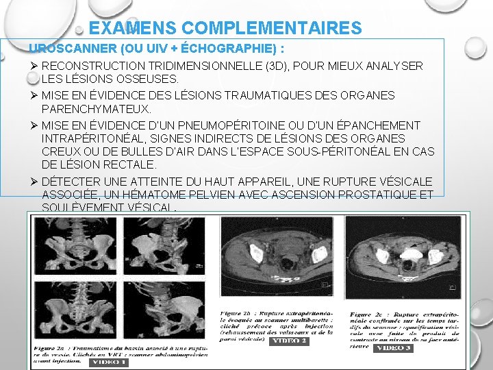 EXAMENS COMPLEMENTAIRES UROSCANNER (OU UIV + ÉCHOGRAPHIE) : Ø RECONSTRUCTION TRIDIMENSIONNELLE (3 D), POUR