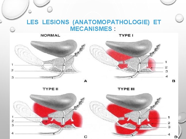 LES LESIONS (ANATOMOPATHOLOGIE) ET MECANISMES : 