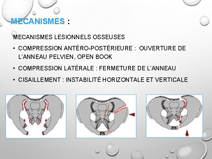 MECANISMES : MECANISMES LESIONNELS OSSEUSES • COMPRESSION ANTÉRO-POSTÉRIEURE : OUVERTURE DE L’ANNEAU PELVIEN, OPEN