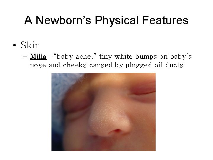 A Newborn’s Physical Features • Skin – Milia- “baby acne, ” tiny white bumps