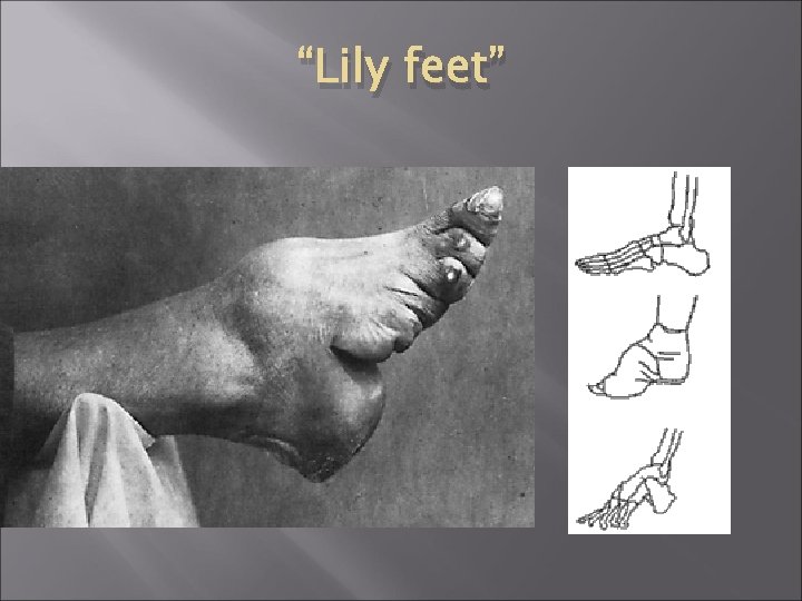 “Lily feet” 