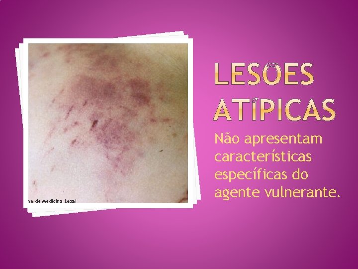 Não apresentam características específicas do agente vulnerante. 