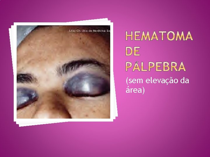 (sem elevação da área) 