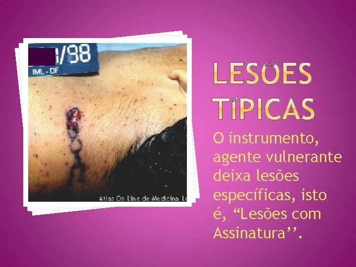 O instrumento, agente vulnerante deixa lesões específicas, isto é, “Lesões com Assinatura’’. 