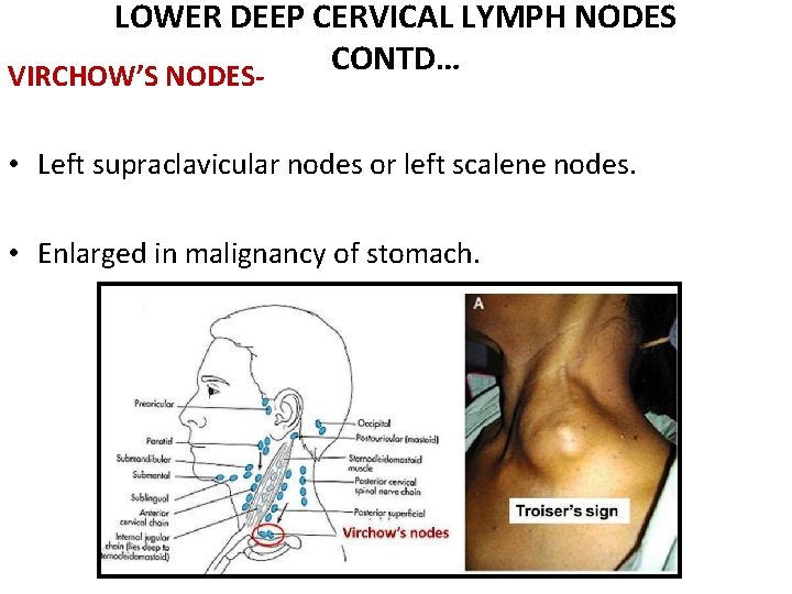 LOWER DEEP CERVICAL LYMPH NODES CONTD… VIRCHOW’S NODES • Left supraclavicular nodes or left LOWER DEEP CERVICAL LYMPH NODES CONTD… VIRCHOW’S NODES • Left supraclavicular nodes or left