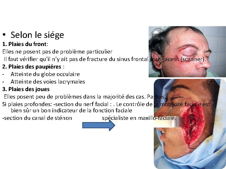  • Selon le siége 1. Plaies du front: Elles ne posent pas de