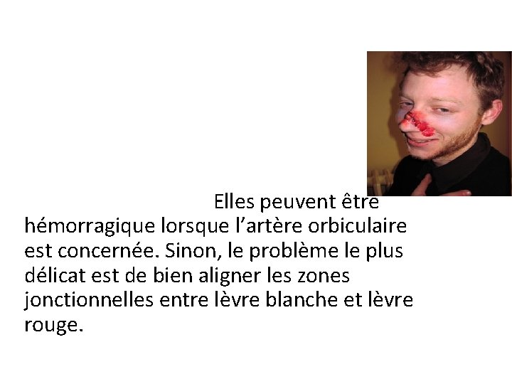  • 4. Plaies du nez: allant de la plaie superficielle a la plaie