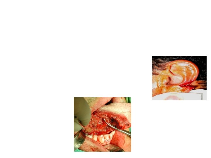  • 6. Plaies du pavillon: tenir compte de l’alignement des cartilages - Risque