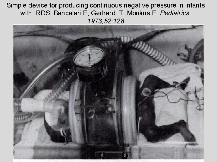 Simple device for producing continuous negative pressure in infants with IRDS. Bancalari E, Gerhardt