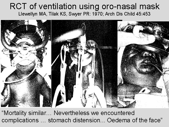 RCT of ventilation using oro-nasal mask Llewellyn MA, Tilak KS, Swyer PR: 1970; Arch