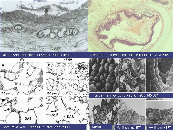Sato K Ann Otol Rhinol Laryngol. 2006 115: 816 Necrotizing Tracheo. Bronchitis Kirpalani H