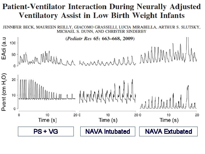 PS + VG NAVA Intubated NAVA Extubated 