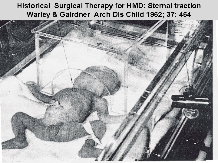 Historical Surgical Therapy for HMD: Sternal traction Warley & Gairdner Arch Dis Child 1962;
