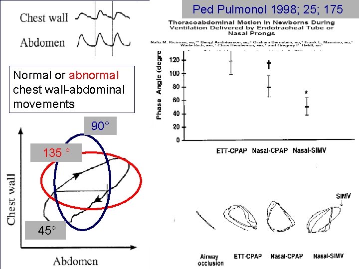 Ped Pulmonol 1998; 25; 175 Normal or abnormal chest wall-abdominal movements 90° 135 °