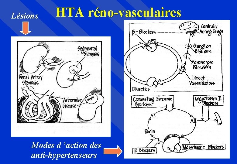 Lésions HTA réno-vasculaires Modes d ’action des anti-hypertenseurs 