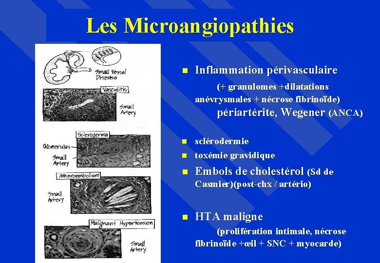 Les Microangiopathies Inflammation périvasculaire (+ granulomes +dilatations anévrysmales + nécrose fibrinoïde) périartérite, Wegener (ANCA)