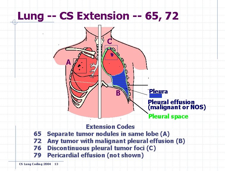Lung -- CS Extension -- 65, 72 C A B Pleural effusion (malignant or