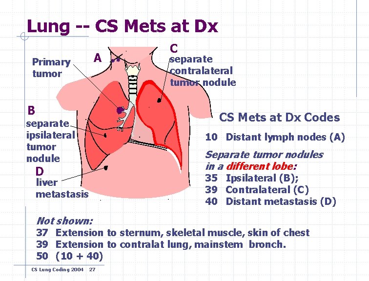 Lung -- CS Mets at Dx A Primary tumor B C separate contralateral tumor