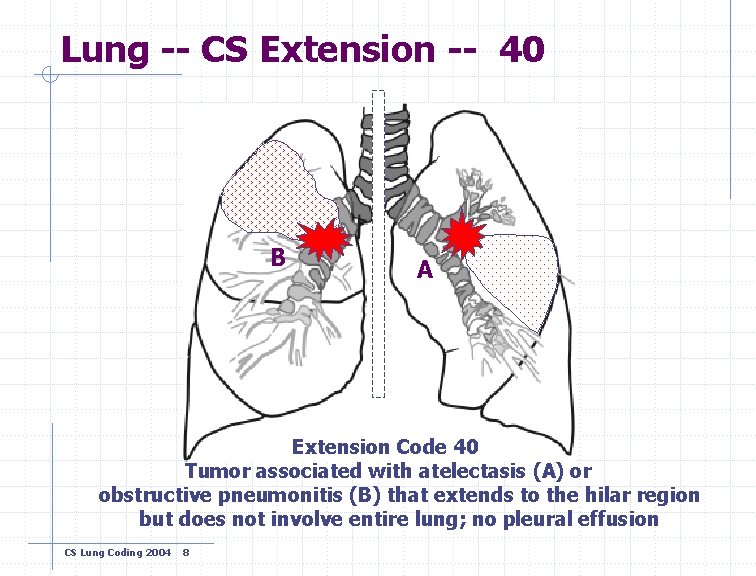 Lung -- CS Extension -- 40 B A Extension Code 40 Tumor associated with