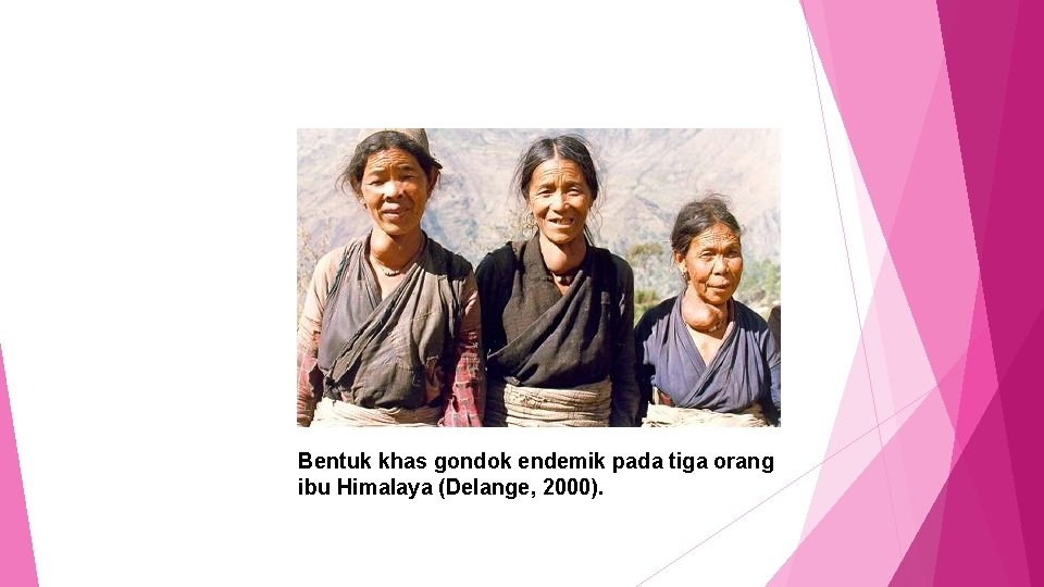 Bentuk khas gondok endemik pada tiga orang ibu Himalaya (Delange, 2000). 