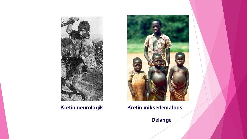 Kretin neurologik Kretin miksedematous Delange, 2000 