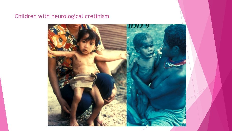 Children with neurological cretinism 