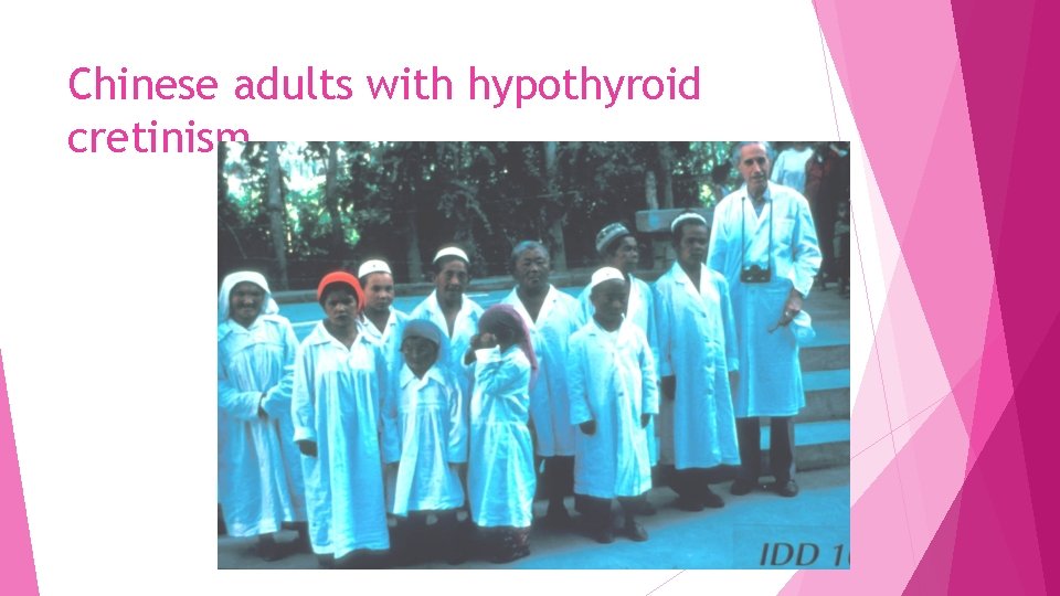 Chinese adults with hypothyroid cretinism 