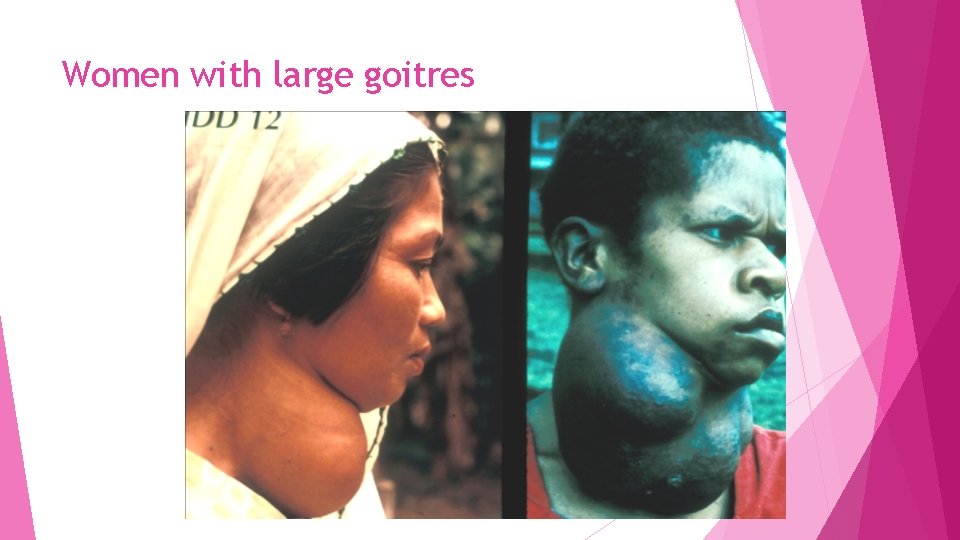 Women with large goitres 